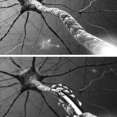 Síndrome de Guillain Barré