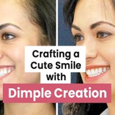 What is Dimple Creation Surgery? | Dimpleplasty | Dimple Creation in Delhi