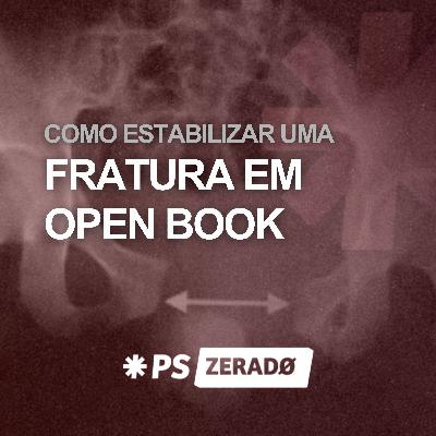 Fratura em open book chegou no PS. O que você faz agora? Fratura em open book chegou no PS. O que você faz agora?