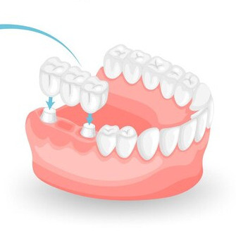 Porcelain Bridges: A Natural-Looking Solution for Missing Teeth