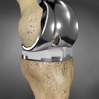Prótese Total do Joelho