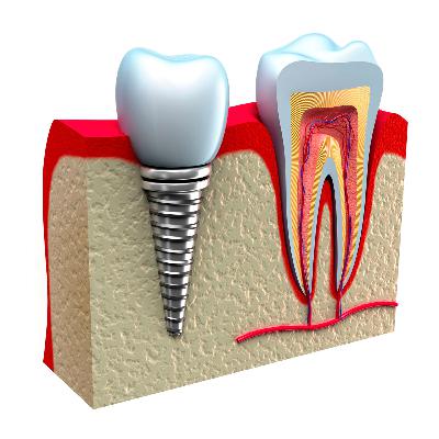 5 dúvidas sobre Implantes dentários