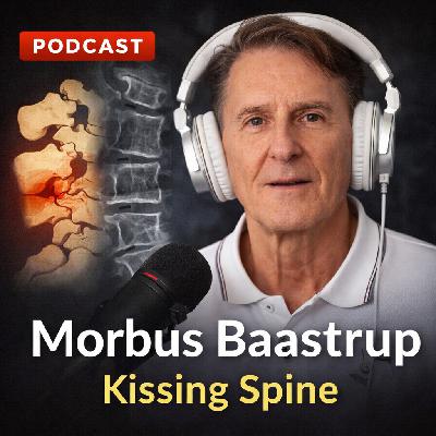 Baastrup-Syndrom – Wenn Dornfortsätze sich "küssen" Baastrup-Syndrom – Wenn Dornfortsätze sich "küssen"