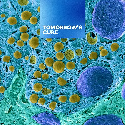 Using AI for Early Detection of Pancreatic Cancer