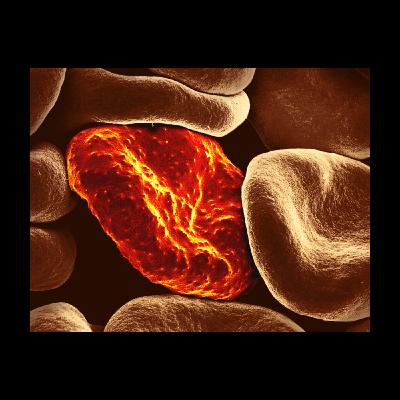ID4U Episode 5 Severe Malaria