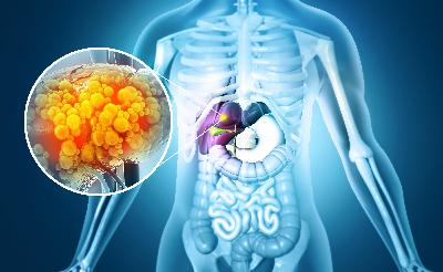 EKU Podcast: Fatty liver disease EKU Podcast: Fatty liver disease