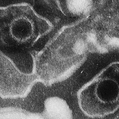 EBV Ties MS Pave Treatments, New Pill Slashes LDL for Statin Patients, AI Stethoscope Detects Heart Disease, Asundexian Slashes Recurrent Strokes, and more...