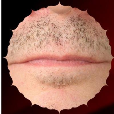 What type of diagnostic tests need to be run to find out the cause of poor beard and moustache hair growth? Is hair transplant a solution? What type of diagnostic tests need to be run to find out the cause of poor beard and moustache hair growth? Is hair transplant a solution?